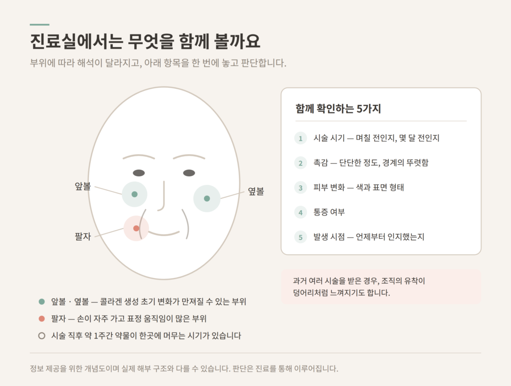 쥬베룩볼륨 결절 진료 시 확인 항목과 앞볼 팔자 옆볼 부위 도식