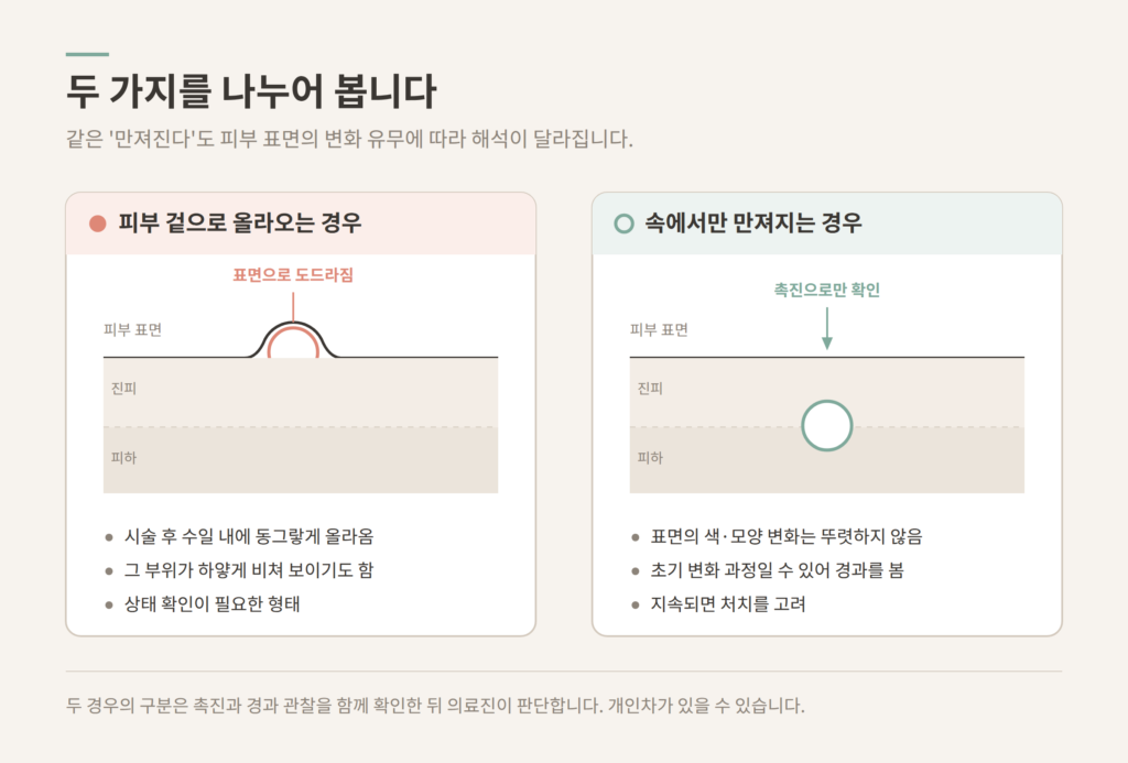 쥬베룩볼륨 결절 피부 표면 도드라짐과 속에서 만져지는 경우 비교 도식