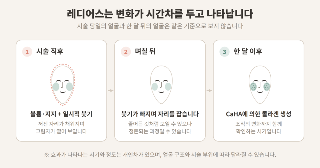 레디어스 시술 직후 붓기 한 달 이후 콜라겐 생성 단계 개념도