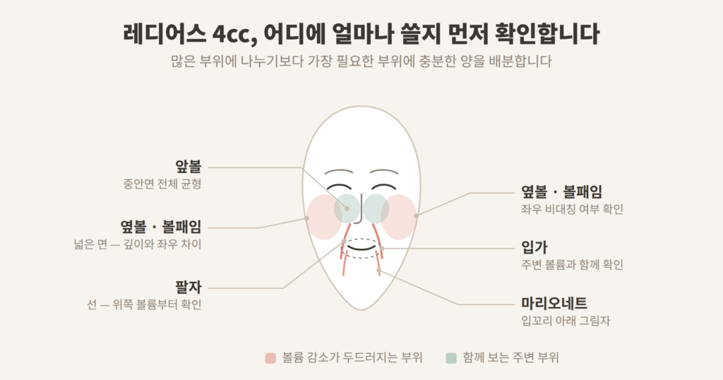 레디어스 4cc 배분 옆볼 앞볼 팔자 입가 마리오네트 확인 부위 개념도