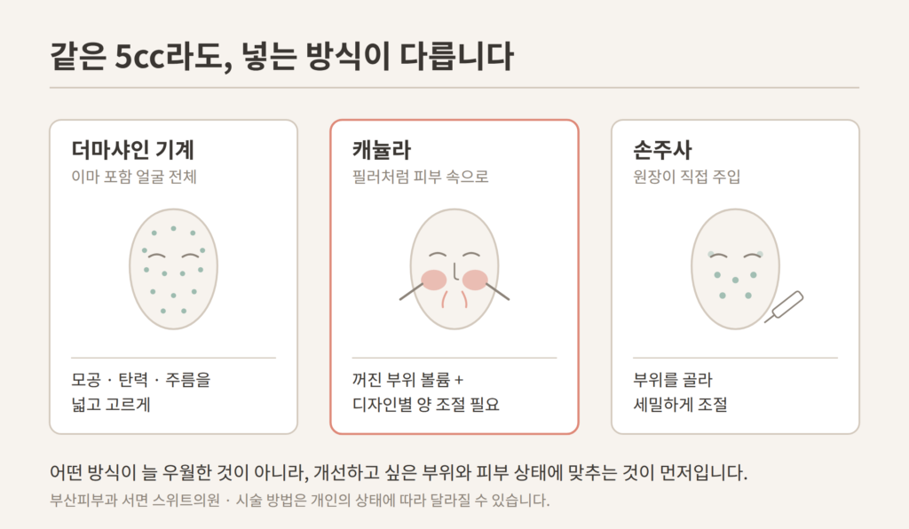 리투오 시술 방법 더마샤인 캐뉼라 손주사 비교 개념도