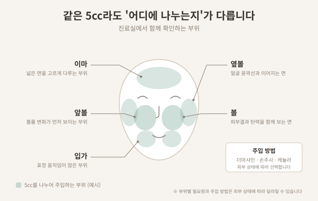 리투오 5cc 얼굴 부위별 배분 이마 앞볼 옆볼 입가 개념도