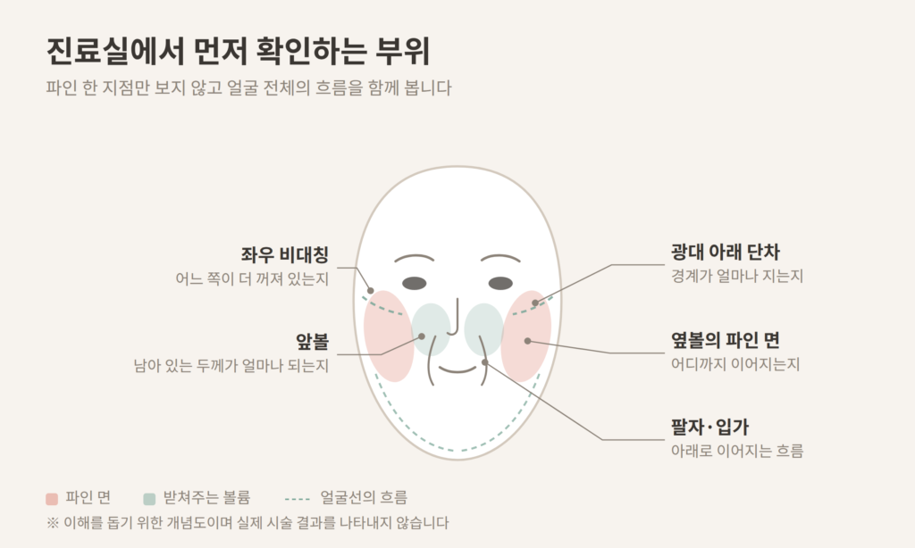 볼패임 상담에서 확인하는 앞볼 광대 옆볼 팔자 부위 개념도
