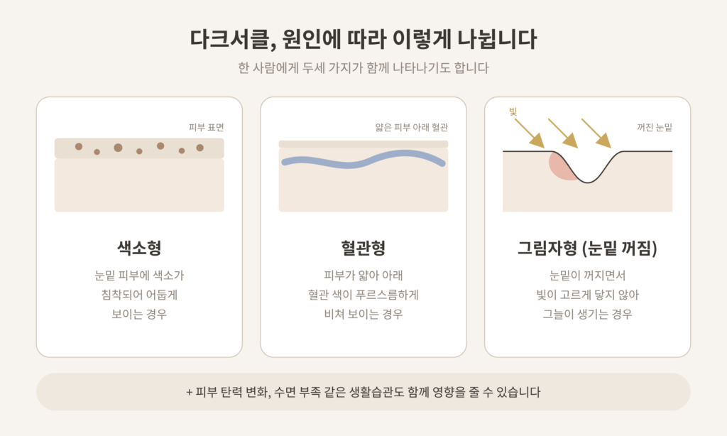 다크서클 원인 색소형 혈관형 그림자형 눈밑꺼짐 비교 도식