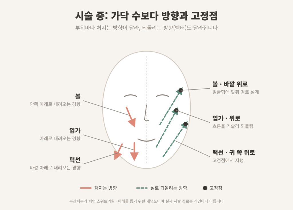 민트실 리프팅 벡터 방향과 고정점 개념도