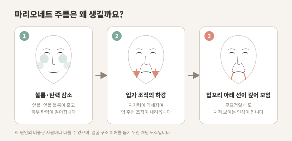 마리오네트 주름 원인 볼륨 탄력 감소 입가 하강 개념도