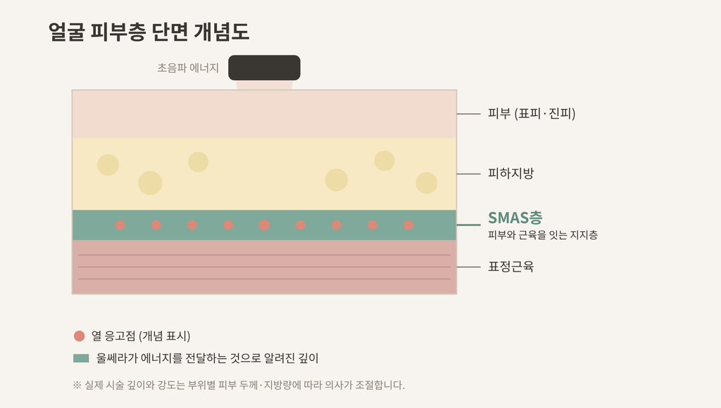 울쎄라 SMAS층 피부층 단면 개념도